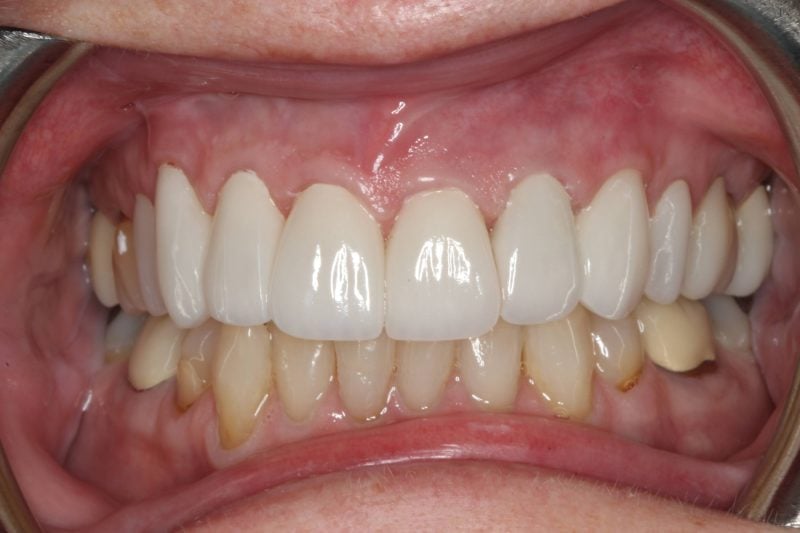 Patient's mouth after dental crown treatment improving tooth appearance and smile aesthetics