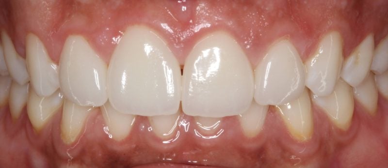 Patient's mouth after porcelain veneers treatment correcting uneven teeth and enhancing smile symmetry