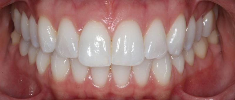 Patient's mouth before Zoom teeth whitening treatment showing a brighter and whiter smile