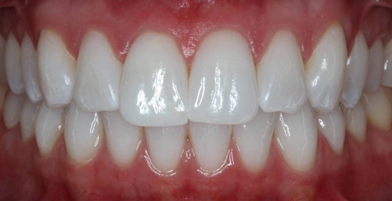 Patient's mouth after Zoom whitening treatment improving tooth color and overall smile appearance