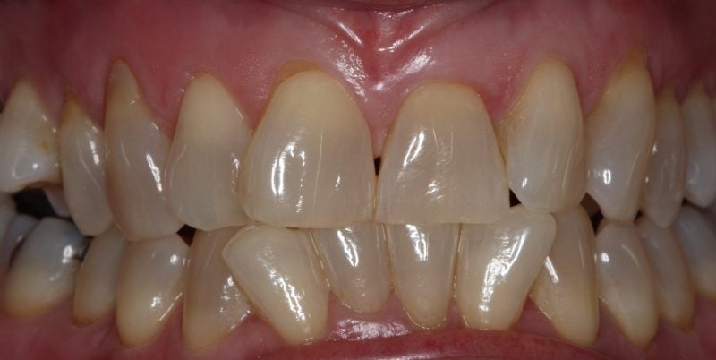 Patient's mouth before Zoom whitening