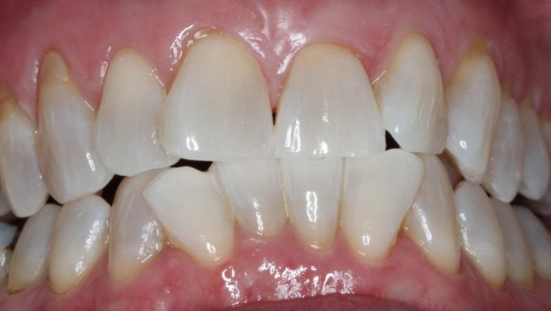 Patient's mouth after Zoom whitening 
