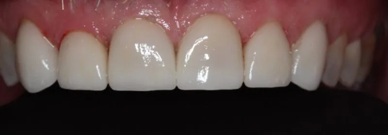 Patient's mouth after dental treatment