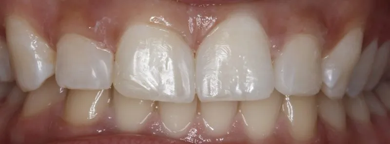 Patient's mouth after dental treatment